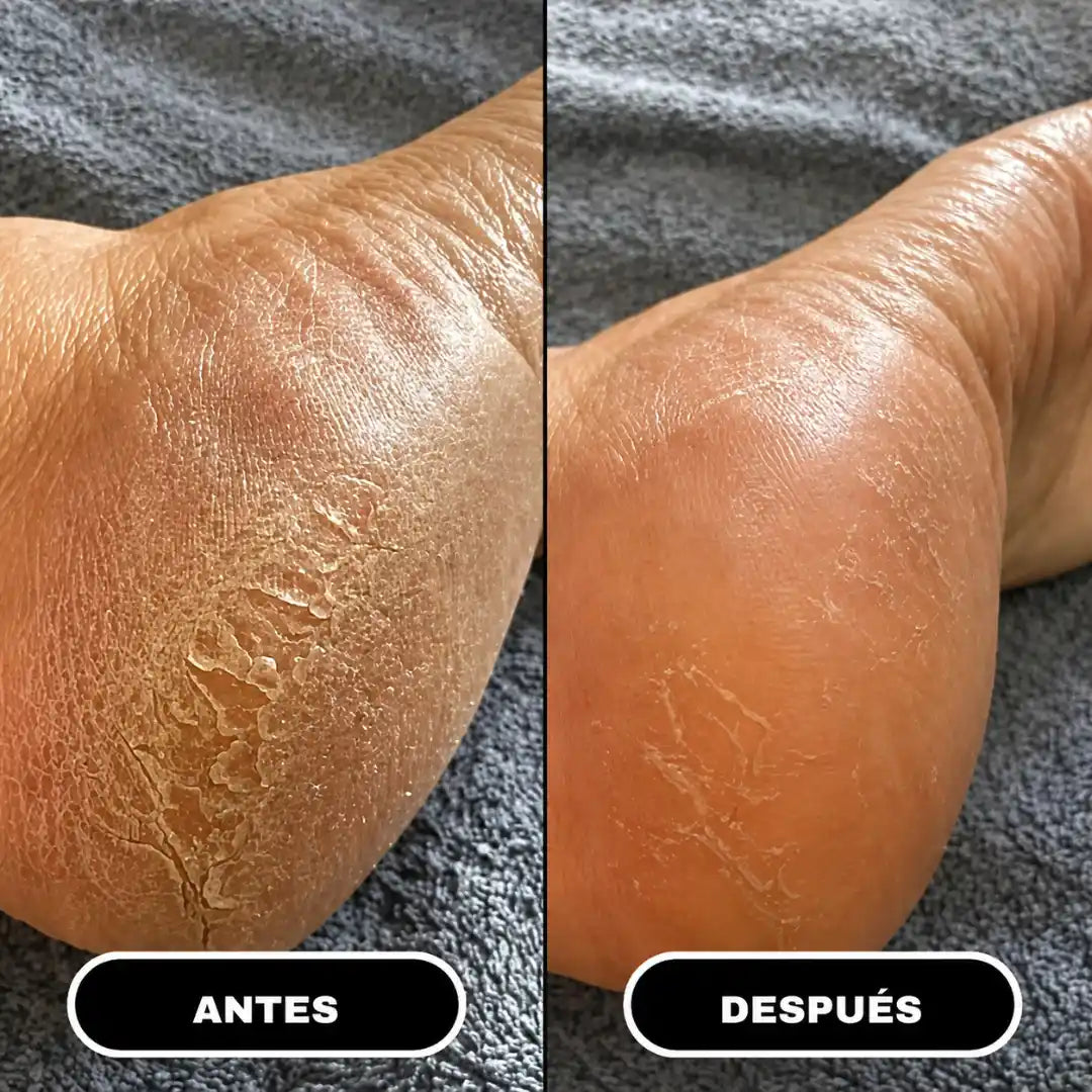 Suavin | Crema Reparadora con Urea 60% para Pies Secos y Agrietados